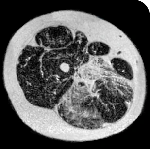 Patient taking Duvyzat 18 months