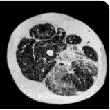 Patient taking Duvyzat 18 months