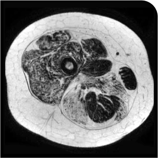 Patient taking placebo 18 months