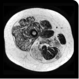 Patient taking placebo 18 months