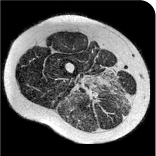 Patient taking Duvyzat baseline
