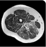 Patient taking Duvyzat baseline