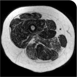 Patient taking placebo baseline