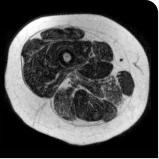 Patient taking placebo baseline